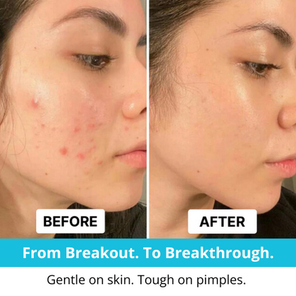 Hydrocolloid Treatment